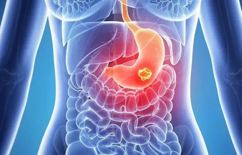胃腸道間質瘤是什么原因造成的
